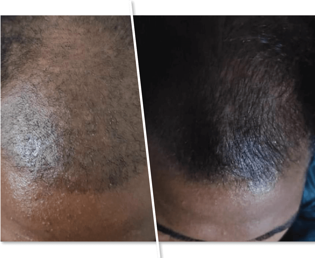 Hair Transplantation Before and After